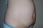 Before surgery