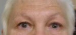 ta eyes before facelift.jpg