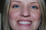 zoom whitening after treatment