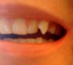 The brunt of my dental dismay - my crooked canine.