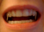A little more than mid-way through treatment. Aligners and bands are on, and you can see how the canine has shifted.