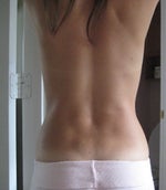 9 months post-op