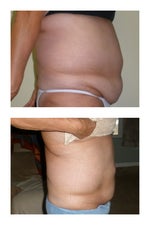 Before and 18 days later, Upper and lower abs only.