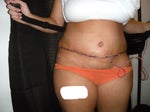 4 days after TT w/ drain (scary I know)
