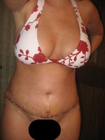 5 DAYS POST OPT SCAR & NEW BB