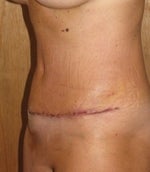 Left view - 10 days