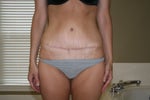 4 months-scar