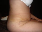 After Tummy Tuck