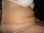 Before Tummy Tuck