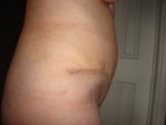 2 weeks after Tummy Tuck