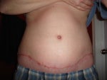 6 weeks/ 2 areas with infection but healing good