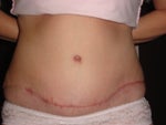 scar at 9 weeks
