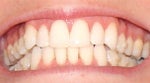 With invisalign - still 6 weeks to go