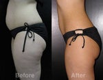 Before & After Side View 