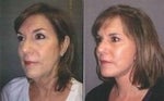 Lifestyle Lift before and after photos