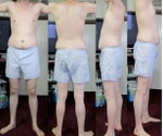 30 year old male considering Liposuction and Tummy Tuck 30 year old male considering Liposuction and Tummy Tuck