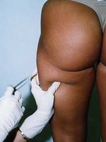 Claim Check: Easy Injections That Smooth Cellulite, Zap Fat, and Erase Dark Circles!