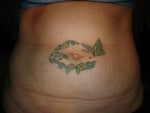 Tattoo removal tummy tuck