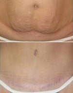 Interest High for Mommy Makeovers, but Is it Worth It?