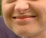 upper teeth don't show anymore