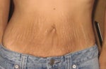 After having 4 children and from yo yo dieting, my stomach is a mess After having 4 children and from yo yo dieting, my stomach is a mess
