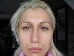 Kyphosys nasi et deviatio septi nasi. Rhinitis hyperplastica