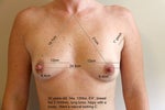 natural slope and cleavage from breast implants natural slope and cleavage from breast implants