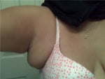 breast lumpectomy axillary tail removal