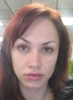 Do I need a Facelift at 31? Do I need a Facelift at 31?