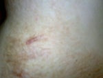 I'm an Asian and I learned that Asians tend to develop keloid and hypertrophic scars. I'm an Asian and I learned that Asians tend to develop keloid and hypertrophic scars.