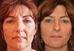 Skin Rejuvenation before and after photos