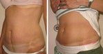 RealBuzz: Is LifeSculpt Laser Lipo Really "A Godsend"?