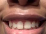 front tooth gap