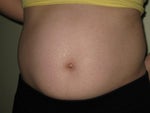 Which non-surgical/non-invasive procedure is best for me? VelaShape or Thermage or something else?
