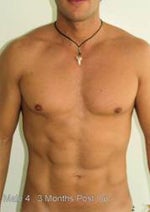 Male after high-def abs surgery