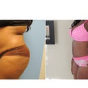 Before and 1 week After PO left side.