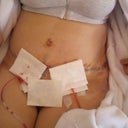 Tummy 5 days post