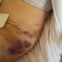 Lots of bruising on flanks