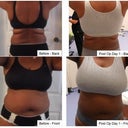 Front and Back Before and Post Op Day 1