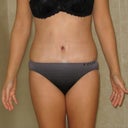 PO week 3.  I think I'm a little fuller at the left waist, compared to the right waist.  What do you think??
