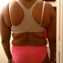 before surgery (back)