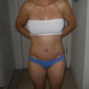 6 weeks post op - Front view
