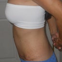 6 weeks post op - left side view