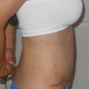 6 weeks post op - right side view
