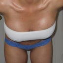 6 weeks post op - bent over front view