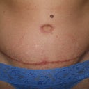 6 weeks post op - tummy tuck close up