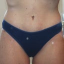 Post Op - 6 weeks