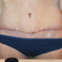 Post Op - 6 weeks - scar closeup