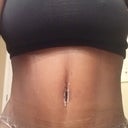 PO Day 15 - Full frontal view