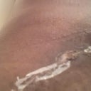 PO Day 15 - Drain wound healing
